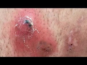 HOW TO GET RID OF INGROWN HAIRS CRAZY