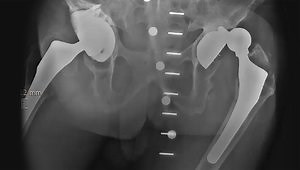Acetabular Solutions in Hip Revision Surgery