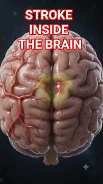 What Happens During a Stroke? 🧠 Inside the Human Brain | 3D Medical Animation#shorts