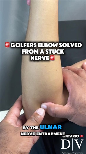 Golfer’s elbow that keeps coming back? 👀⚠️ The problem might not just be an irritated tendon or tight forearm muscles. What if the real issue is ulnar nerve entrapment near the inside of the elbow? The ulnar nerve travels behind the medial epicondyle on the inside of the elbow. When the nerve and surrounding tissues become restricted, it can contribute to: 🔥 chronic pain on the inside of the elbow 🔥 aching or burning into the forearm 🔥 tingling into the ring or pinky finger 🔥 discomfort wit