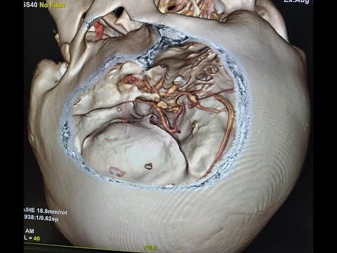 Brain surgery/aneurysm surgery/Left pterional craniotomy and ACOM aneurysm clipping