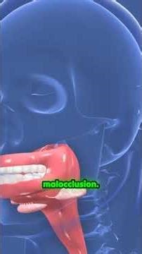 Balancing Functional Malocclusion: Why Bruxism and CO–CR Differences Drive TMD 🦷