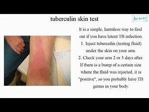 tuberculin skin test (English) - Medical terminology for medical students -