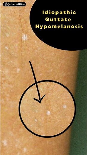 Idiopathic Guttate Hypomelanosis | what is white spotting skin #whitespots #agespots #dermatology
