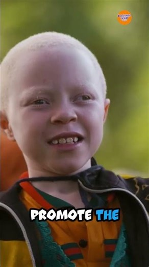 The Sad Life of being Albino in Africa! Woah