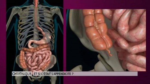 Appendicite 1. Définition L'appendicite est une inflammation aiguë de l'appendice, un segment d'intestin d'une dizaine de centimètres situé au niveau de la première partie du gros intestin. Elle provoque des douleurs abdominales, de la fièvre ou des troubles digestifs. Le traitement repose le plus souvent sur la résection de l'appendice infecté. 2. Symptômes D'habitude, le début est brutal avec une douleur vive située dans la fosse iliaque droite (FID) qui est la zone en bas et à droite de l'omb