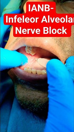 #Inferior alveolar nerve block #root canal treatment #dental treatment #endodontist #RCT specialist