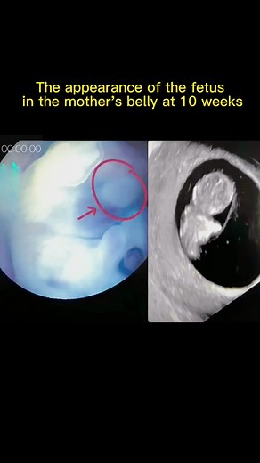 Week 10 Pregnancy: Fetal Development and Appearance