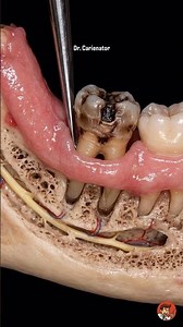 This Tooth Was Too Damaged to Save 😳🦷