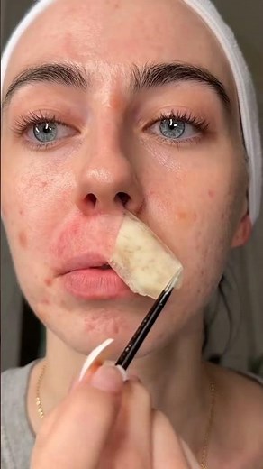 DIY Face Mask for Acne & Pimples | Turmeric, Honey & Almond Remedy for Clear Skin Fast in 7-Day Only