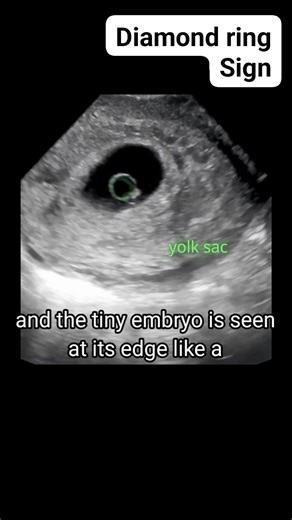 💍 Diamond Ring Sign in Ultrasound A stunning visual with powerful diagnostic value—this sign isn’t just beautiful, it’s meaningful. Seen in early pregnancy ultrasounds, the “diamond ring” appearance can help confirm gestational sac presence and viability. Radiology meets elegance in this fascinating moment of prenatal imaging. 🎥 Watch, learn, and share the sparkle of science! #ViralReels #ViralVideoシ #EducationalReels #Radiology #MedicalEducation #PregnancyCare #UltrasoundMagic #DiamondRingSig
