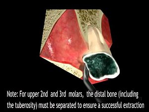 Physics Forceps Posterior Animation