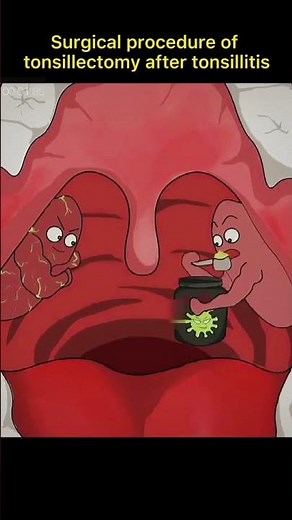 Surgical procedure of tonsillectomy