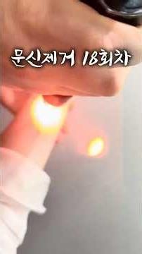 문신제거 비용 얼마냐구요?