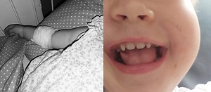 Zielona Góra. Mała Zosia rozcięła sobie język. Czekała DOBĘ na zabieg przez COVID!