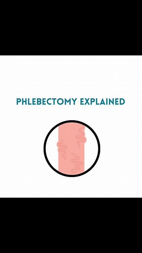 #phlebectomy #veintreatment #varicoseveins #spiderveins #venaschallenge #venasarañas #varicoseremoval