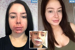 Banker whose acne resembled a ‘BEARD’ dumped boyfriend who was ‘ashamed’ of her