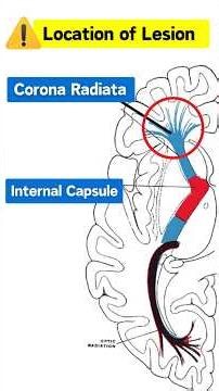 Internal Capsule vs Corona Radiata, Same Stroke Weakness, Different Recovery.