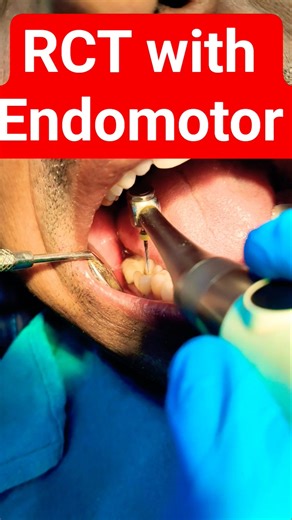 RCT with Endomotor #RCT #Root canal Treatment #dental treatment #endodontist #root canal specialist