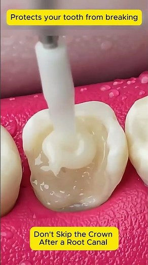 Post & Crown Restoration After Root Canal