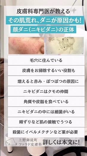 顔ダニ・ニキビダニ治したい方 #皮膚科専門医 #美容皮膚科 #スキンケア