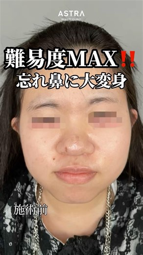 [Transform a thick, challenging nose into a sleek one✨👀 Check out the video to see the final resu...