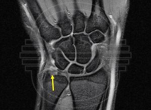 CIRUGIA de la LESION del FIBROCARTILAGO TRIANGULAR - Miembro Superior