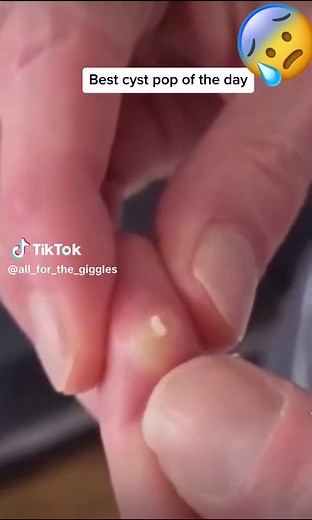 Best cyst pop on finger ever. #cystpopping #cystremoval #oddlysatisfying #cystsqueeze #pimplepopping