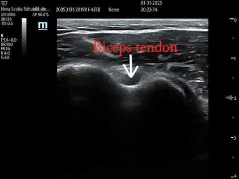 Biceps tendon sheath injection