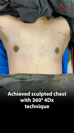 Grade 2A Gynecomastia Before and After Surgery | Gynecomastia Clinic in Delhi #shortsfeed