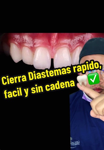 Cierra Diastemas Rápido y Fácil sin Cadenas 🦷✅