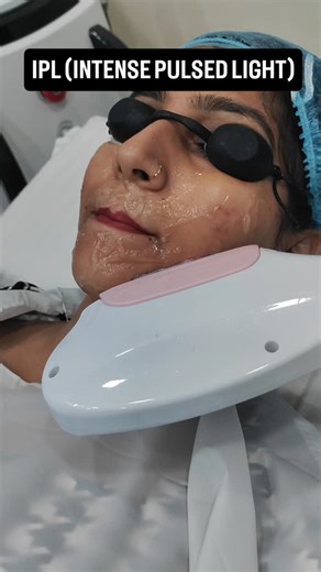 Skin Laser and Dental Care on Instagram: "IPL (INTENSE PULSED LIGHT ) is a broad spectrum light based treatment to target Acne and it's related redness. *How IPL works:- 1. Kills acne-causing bacteria The light activates porphyrins produced by C. acnes bacteria This reaction creates oxygen radicals that destroy the bacteria Fewer bacteria = fewer inflammatory breakouts 2. Reduces inflammation and redness IPL targets hemoglobin in blood vessels This shrinks dilated vessels that cause acne redness