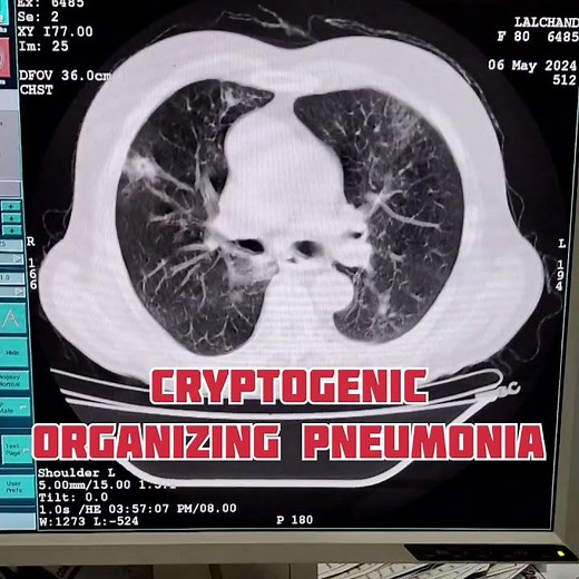 Cryptogenic organizing pneumonia #pneumonia #radiology #shortvideo