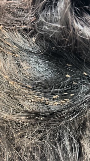 Watch the Full Lice Treatment Video! #Licetok