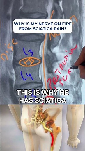 Burning Sciatica Pain? Discover How Spinal Decompression Eased Nerve Pressure #BackPainRelief