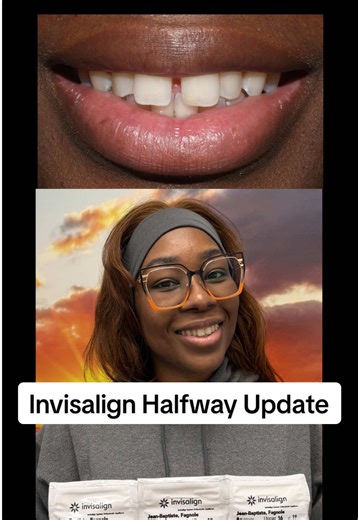 Halfway there and already loving the results! When she started her Invisalign journey, her biggest concern was the gap between her front teeth. Now, only halfway through treatment, that gap is almost completely closed—and she couldn’t be happier with how everything is progressing! We’re so excited for her and can’t wait to see her final smile transformation. 🦷✨ Ready to start your own Invisalign journey? 📞 Call 954-796-9900 or click the link in our instagram bio to reserve your Invisalign cons