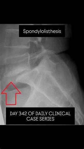 dx.diaries on Instagram: "🦴 SPONDYLOLISTHESIS ✨ Interesting Fact: Spondylolisthesis refers to anterior slipping of a vertebra over the one below it, most commonly at L5–S1. Etiology: 🔹 Isthmic (pars interarticularis defect) – most common 🔹 Degenerative 🔹 Dysplastic 🔹 Traumatic 🔹 Pathological Key Features: 🔹 Low back pain 🔹 Pain aggravated on standing or extension 🔹 Hamstring tightness 🔹 Radicular pain if nerve compression present 🔹 Postural abnormalities Other Important Findings: 📍 S