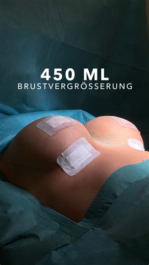 Dr.med. Nauras Abuagela, M.D. & Kollegen on Instagram: "Brustvergrößerung - 450 ml Implantate im hohen Profil, natürlicher Übergang, keine Straffung. Stabilisiert durch einen inneren BH, der das Implantat zuverlässig positioniert. Dank Fast-Recovery-Methode: Ambulant, schmerzarm, schnell wieder fit. Moderne Brustchirurgie bedeutet heute vor allem: schonend, planbar, alltagstauglich. #plastischechirurgie #frankfurt #dnaplasticsurgery #brustvergrößerung"