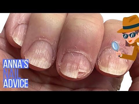 Strange Nail Damage After Builder Gel? [ANNA'S NAIL ADVICE]