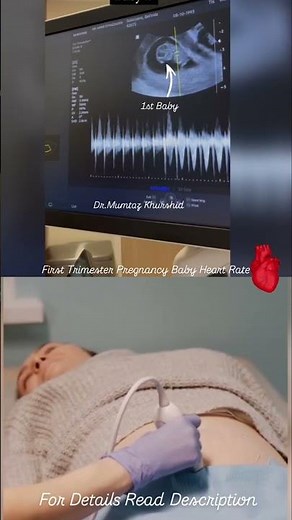 8 Weeks Baby Heart Beat on ultrasound scan| It's a twin Baby 🐥🐥