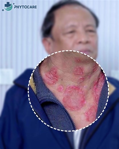 💥 ITCHING, FLAKING, SLEEPLESS NIGHTS 𝗧𝗛𝗘 𝗗𝗔𝗜𝗟𝗬 𝗦𝗧𝗥𝗨𝗚𝗚𝗟𝗘 𝗢𝗙 𝗘𝗖𝗭𝗘𝗠𝗔 Red, burning patches that peel can leave your whole body itchy and sore. Nights are sleepless from the itch; days feel insecure with dry, cracked, rough skin. Many people have tried countless ways without lasting relief – until they found a 𝘀𝗼𝗹𝘂𝘁𝗶𝗼𝗻 𝗮𝘁 𝗣𝗵𝘆𝘁𝗼𝗰𝗮𝗿𝗲 𝗗𝗲𝗿𝗺𝗮𝘁𝗼𝗹𝗼𝗴𝘆: 👉 Our eczema care program helps you: ✅ Soothe inflamed, red areas quickly and ease itching noticeably 