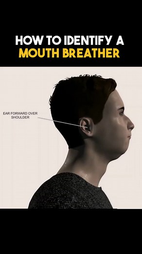 Identifying Mouthbreathers: Signs, Symptoms, and Solutions