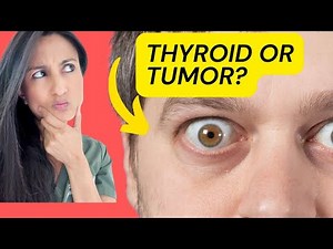 Warning: Bulging Eyes Are Not Normal | What causes bulging eyes | Thyroid eye disease | Eye tumor