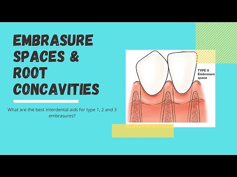 What are embrasure spaces and root concavities? Let's look at interdental aids!