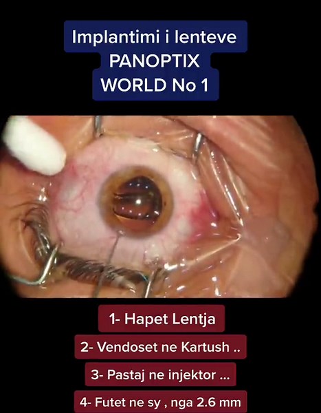 Panoptix Lens Implantation Procedure at European Eye Clinic