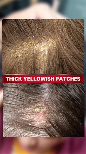 Main reason for dandruff 😲 #ytshorts #skincare #haircare #glowingskin