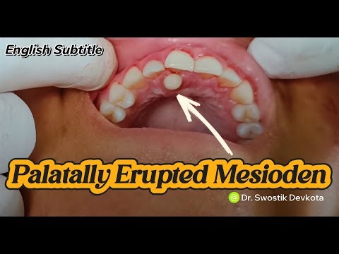🇳🇵Palatally Erupted Mesiodens| Supernumerary Tooth| Conical Tooth| Dr. Swostik Devkota| Extraction