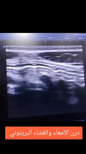 #TB_Peritonitis. مـركز إمام للكبد ومناظير الجهاز الهضمي | د.السيد إمام