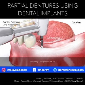 醴⭐ Partial Dentures Using Dental Implants FOLLOW @MalaysiaDental for More Dental Videos ! [헦헛헔헥험 / 헧헔헚]  #ortho #veneers #prosthodontics #dentalhygiene #healthysmile #oralhealth #dentalhealth #dentalcare #dentistmalaysia #dentures #dentallab #dentalschool #dentalassistant #dentallife #smilemakeover #invisalign #orthodontics #dentist #cosmeticdentist #dentalhygienist #dentistlife #orthodontics | Dentistsnearby.com | Facebook