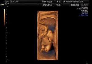 File:Fetal movements 3D Ultrasound Dr. Wolfgang Moroder.theora.ogv - Wikimedia Commons